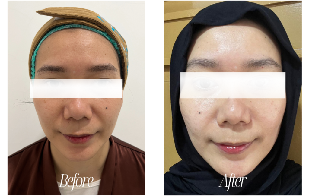 befor after skinbooster laser