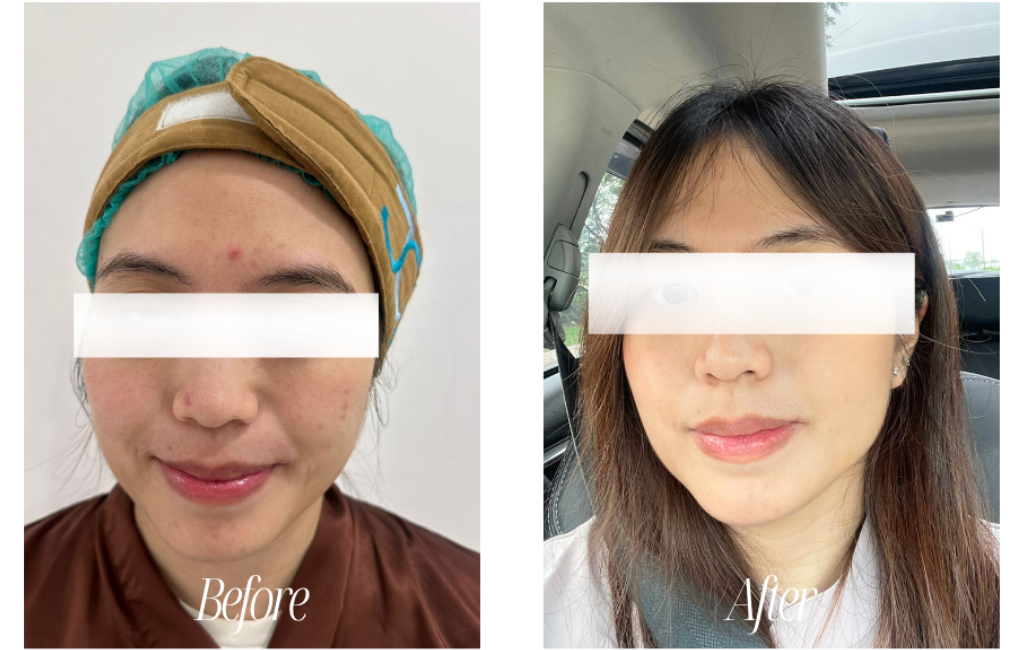 before after skinbooster exosome