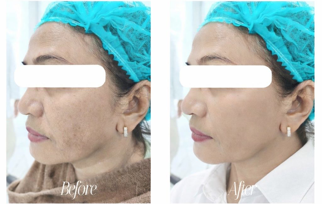 testi before after skin booster rejuran