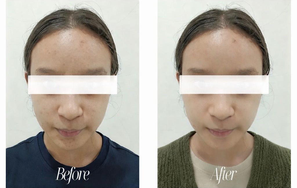 testimoni before after skin booster rejuran 2