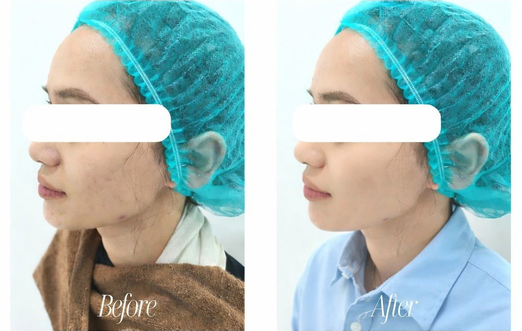 testimoni before after skinbooster rejuran